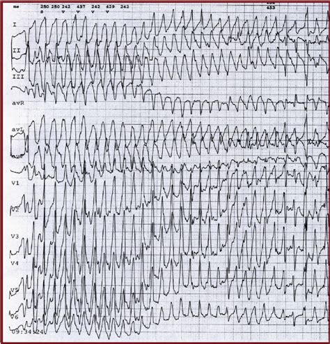 Torsades de pointes ventricular tachycardia (Patient1) during the... | Download Scientific Diagram