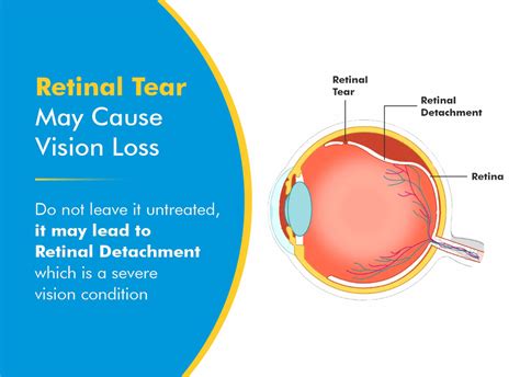 Is Retinal Tear A Medical Emergency? Facts To Know!