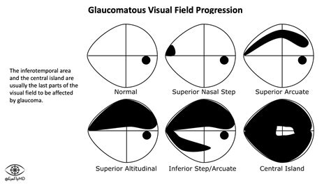 Glaucoma Visual Field