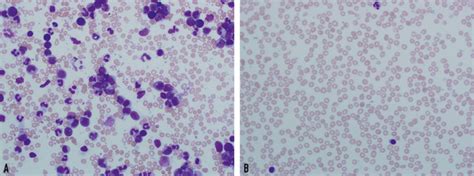 Nico Gagelmann on Twitter: "Intro: -Hyperleukocytosis (HLC) often ...