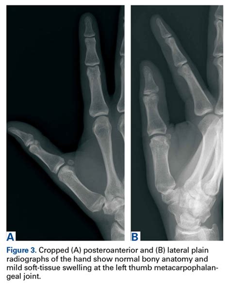 Multimodality Approach to a Stener Lesion: Radiographic, Ultrasound ...