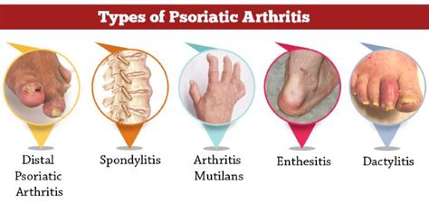 Psoriatic arthritis symptoms pictures, pics of psoriatic arthritis ...