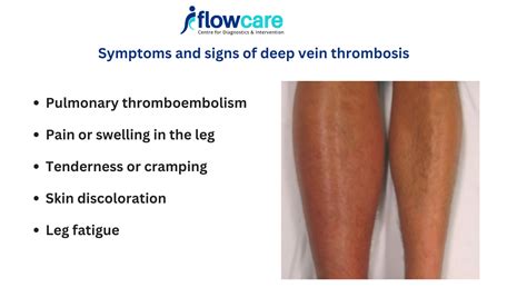 Symptoms and signs of deep vein thrombosis | Treatment