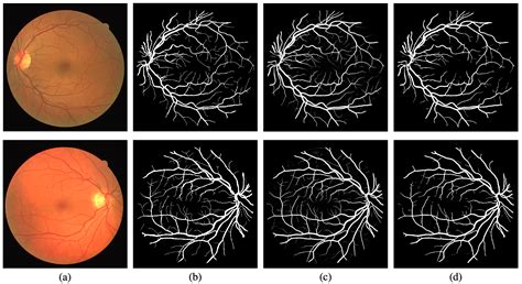 Retinal Vessel Segmentation based on Fully Convolutional Networks ...