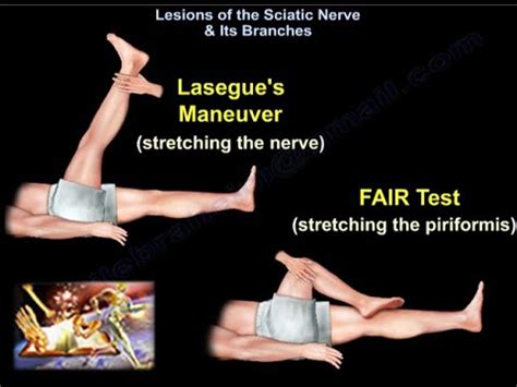 Lesions Of The Sciatic Nerve & Its Branches - Everything You Need To ...