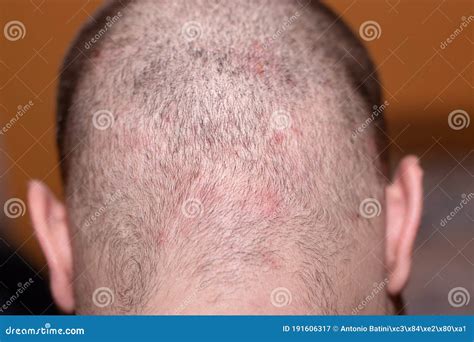 Back Side of a Man`s Head Suffering from Scalp Acne Stock Image - Image of eczema, care: 191606317