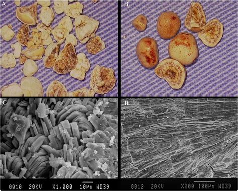 Morphologic characteristics of Calcium Oxalate Monohydrate stones from ...