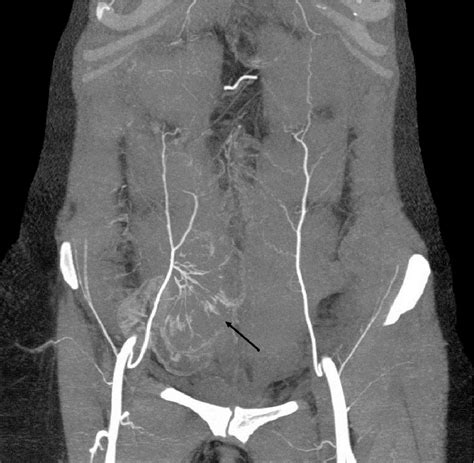 Figure 8 from Analysis of deep inferior epigastric artery perforating vessels with CT ...