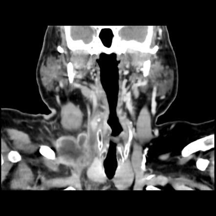 Supraclavicular Lymph Nodes Location