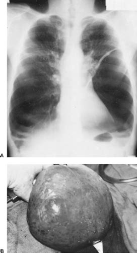 Bullous and Bleb Diseases of the Lung | Thoracic Key