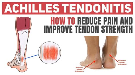 Achilles Tendinopathy And Achilles Tendon Partial And Full Thickness ...