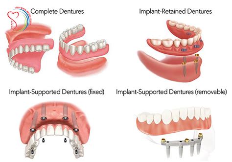 Should restore dental implant or fitting dentures or dental bridges?