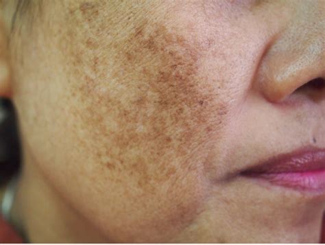 Melasma | Craig Singer MD Dermatology