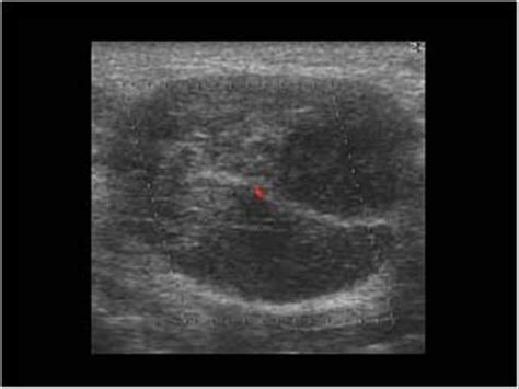 Head and Neck | 4.3 Salivary glands : Case 4.3.4 Warthin's tumors | Ultrasound Cases