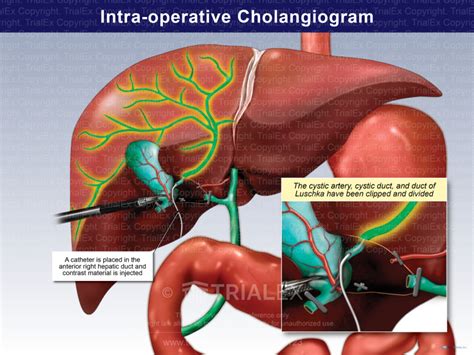 Intra-operative Cholangiogram Anterior View - TrialExhibits Inc.