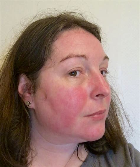 Lupus can cause a red butterfly-shaped rash across the nose and cheeks ...