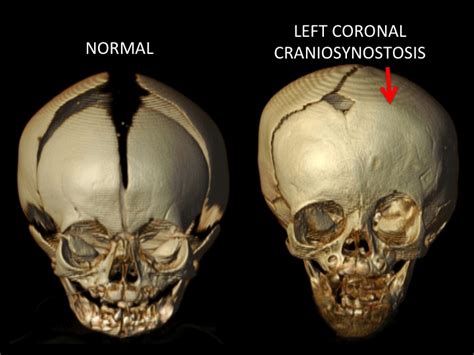 Coronal Synostosis — Dallas Pediatric Plastic Surgeon, Craniofacial Surgeon, Cleft Lip and ...