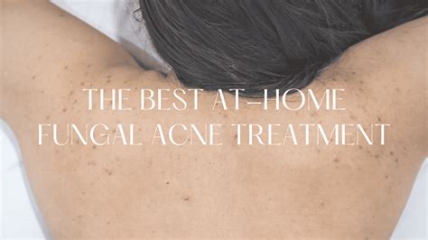 Best Fungal Acne Treatment At Home: The Ultimate Guide - Hello Mia Wilson