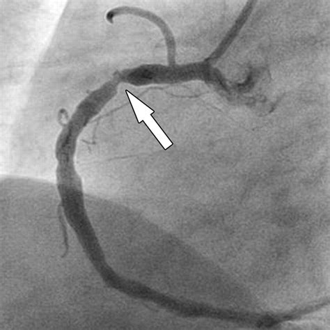 Cardiac Catheterization Cardiac Angiography And Coron - vrogue.co