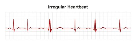 What Does An Abnormal ECG Mean? - Capital Heart Centre