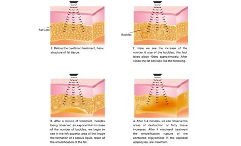 Cavitation - Cosmetic Laser Professionals