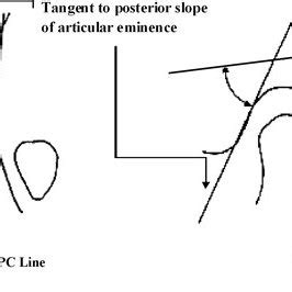 Sagittal section of MRI showing determination of eminence angle ...