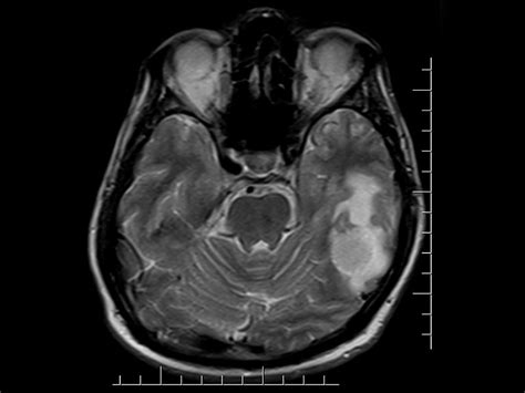 Traumatic Brain Injury ED Visits Up Nearly 30% in 5 Years