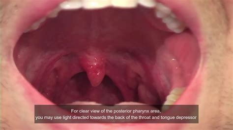 Oropharyngeal Swab - YouTube