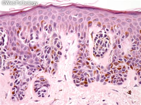 Webpathology.com: A Collection of Surgical Pathology Images