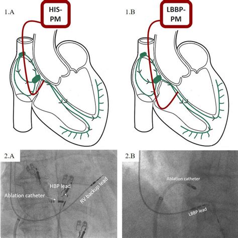 Schematic representation of pacemaker (PM) lead positions (1) and their... | Download Scientific ...