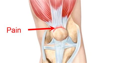 Quadriceps Tendonitis (Tendinopathy) - Sportsinjuryclinic.net