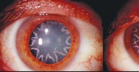 Electrical Burn Causes Star-Shaped Cataracts in Patient's Eyes