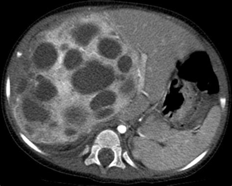 Liver Atlas: Case 65: Hamartoma, mesenchymal