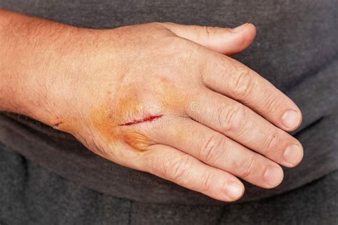 Man`s Hand with a Cut Wound, a Cut Hand Stock Image - Image of damaged ...