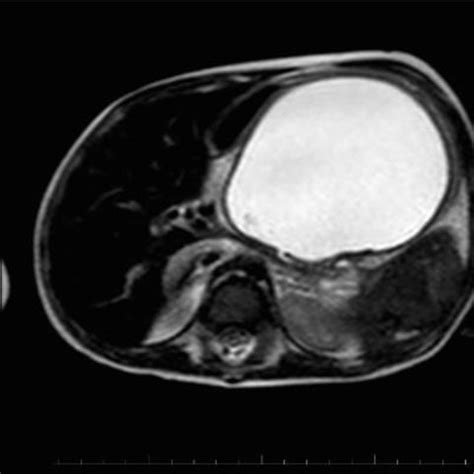 MRI showing a large cystic collection of fluid in front of body and... | Download Scientific Diagram