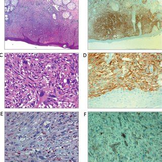 Typical presentation of atypical fibroxanthoma (AFX). a: Overview of... | Download Scientific ...