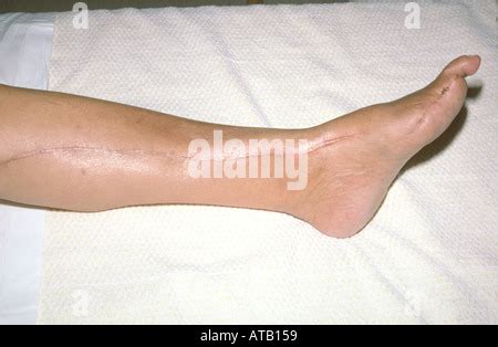 Vascular bypass surgery leg Stock Photo - Alamy