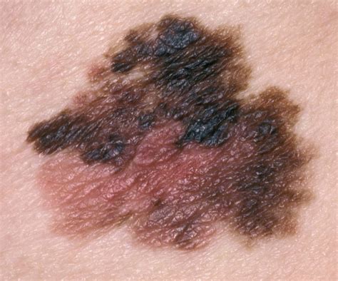 Melanoma Skin Cancer On Back