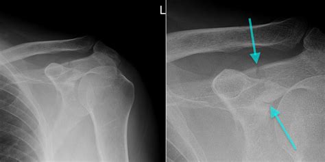 Acromion Fracture - Radiology at St. Vincent's University Hospital