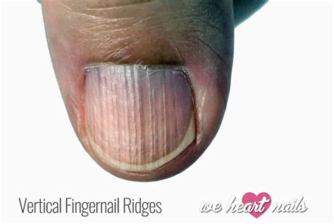 Vertical Ridges on Nails - Causes, Prevention & Treatment