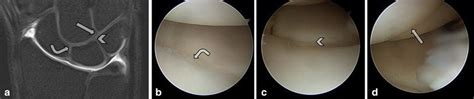 Normal midcarpal joint anatomy. Coronal fat-suppressed T1-weighted MR ...