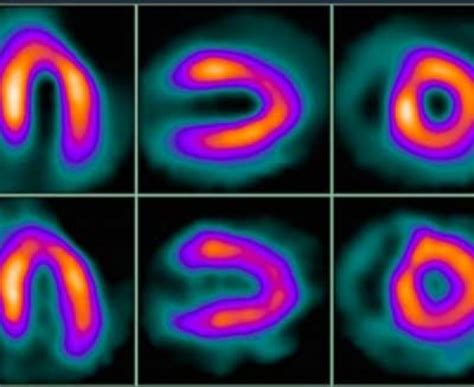 Myocardial Perfusion Imaging (MPI) Test - Healthy Heart Institute