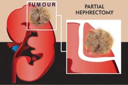 Radical Nephrectomy - Chin Chong Min Urology