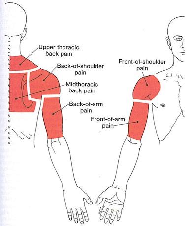 Upper Back, Shoulder, and Arm | The Trigger Point & Referred Pain Guide