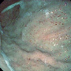 Confluent red spots in portal hypertensive gastropathy (A. white light ...