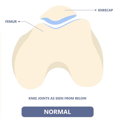 Patella Dislocation - How Long is Recovery Time? | Jeremy Burnham, MD