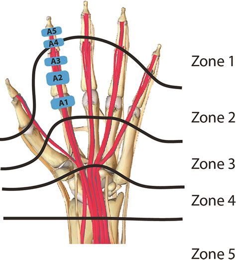 Flexor Tendon Zones Of Hand | sexiezpix Web Porn