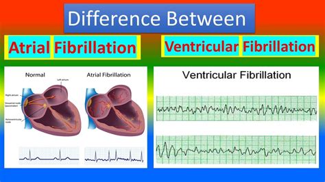 Ventricular Flutter Vs Fibrillation