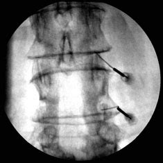 SI and Facet Joint Injection - Imaging Glossary - Patients - UR ...