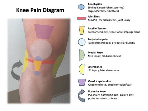 Types Of Knee Pain Diagram | My XXX Hot Girl